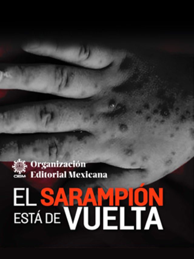 Sarampión